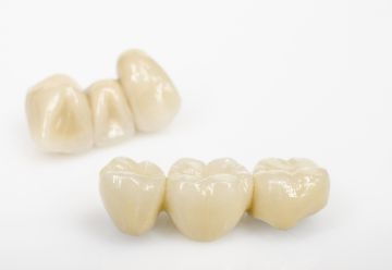Почему металлокерамические коронки рекомендуют к установке стоматологи
