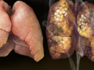 Как выглядят внутренние органы курильщика (фото, не для слабонервных)