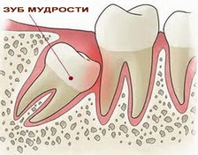 Стоматологи Вива-Дент: «При наличии показаний зубы мудрости следует удалять»