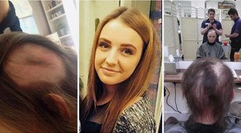 Девушка-подросток из Англии осталась без своих волос из-за болезни
