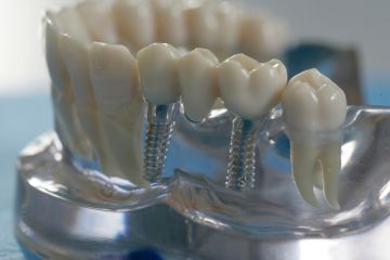 Качественная имплантация зубов в стоматологической клинике «Династия Н»