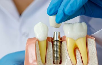 Акция по стоматологии «Имплантация под ключ» в Medical Star