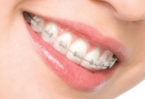 «Изменение прикуса – процесс результативный в любом возрасте!», – утверждают врачи стоматологии на Позняках «Вива-Дент»