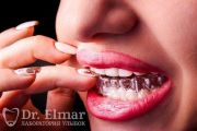 Ультрасовременные виниры Refractor и авторские эльмайнеры – как звездный стоматолог и владелец клиники «Лаборатория улыбок Dr.Elmar» Эльмар Бабаев создает улыбки