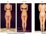 Центр Ручная Пластика® - коррекция линий, пропорций и форм женской фигуры без лишнего веса.